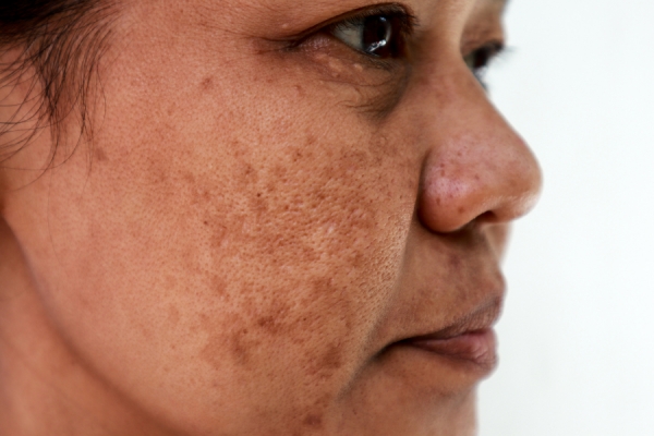 Pigmentation Protocol: From Treatment to Prevention &amp; Everything In-Between