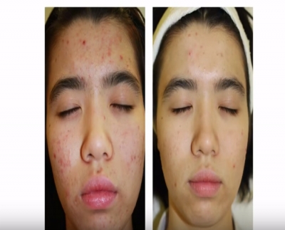 Video: DMK's non-invasive anti-acne treatment you have to try!