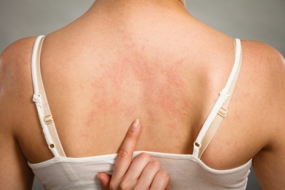 Understanding Urticaria: Triggers, Causes, Types, and Variances