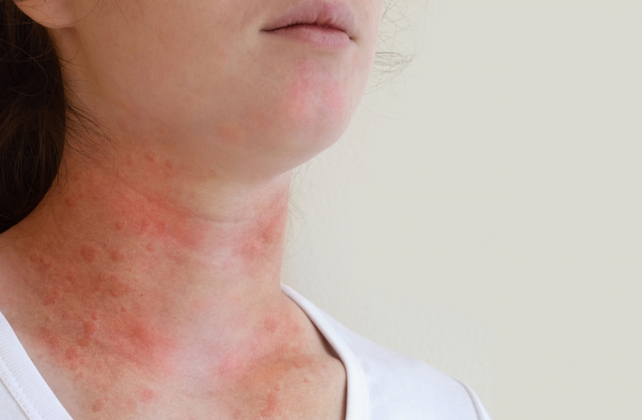 hives on face and neck