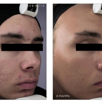 Dr. Kouros Azar the ONLY Plastic Surgeon in America to Introduce New Acne Treatment